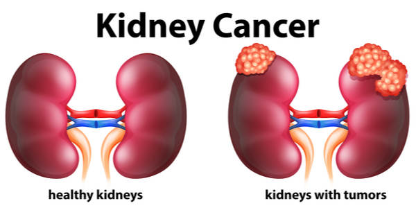 Kidney Cancer Treatment in Mumbai | Dr. Mangesh Patil | Kidney Specialist