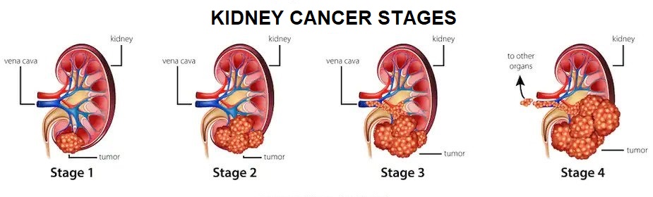 Kidney Cancer Treatment in Mumbai | Dr. Mangesh Patil | Kidney Specialist