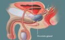 overview of localized prostate cancer