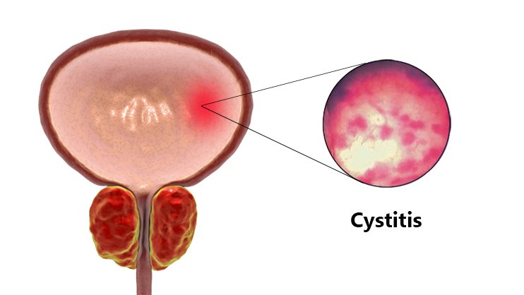 Interstitial cystitis (IC)