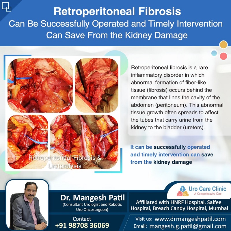 Retroperitoneal fibrosis