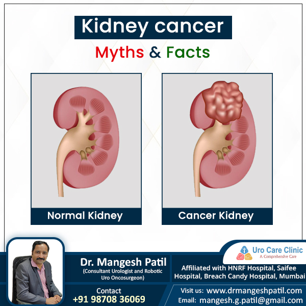 Kidney cancer myths and facts