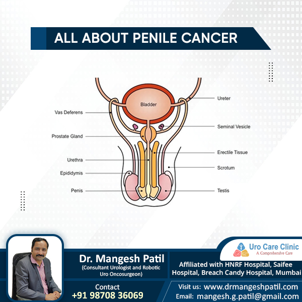 Penile cancer treatment in mumbai